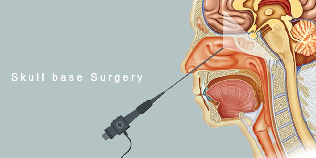 Skull Base Surgery Neurospine Hospital And Revive Critical Care 7439