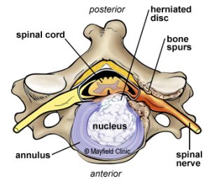 Microscopic Anterior Cervical Discectomy - Neurospine Hospital & Revive ...